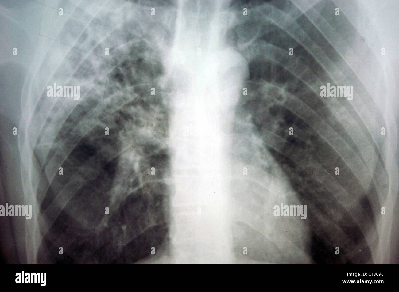 X-ray de cage de rip Banque D'Images