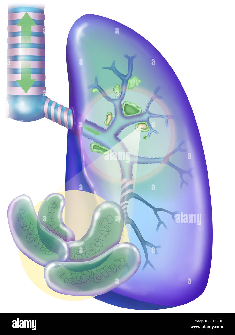 La tuberculose, dessin Banque D'Images