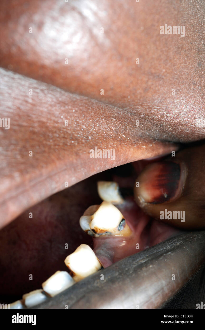 L'inspection d'un dentiste dent en décomposition Banque D'Images