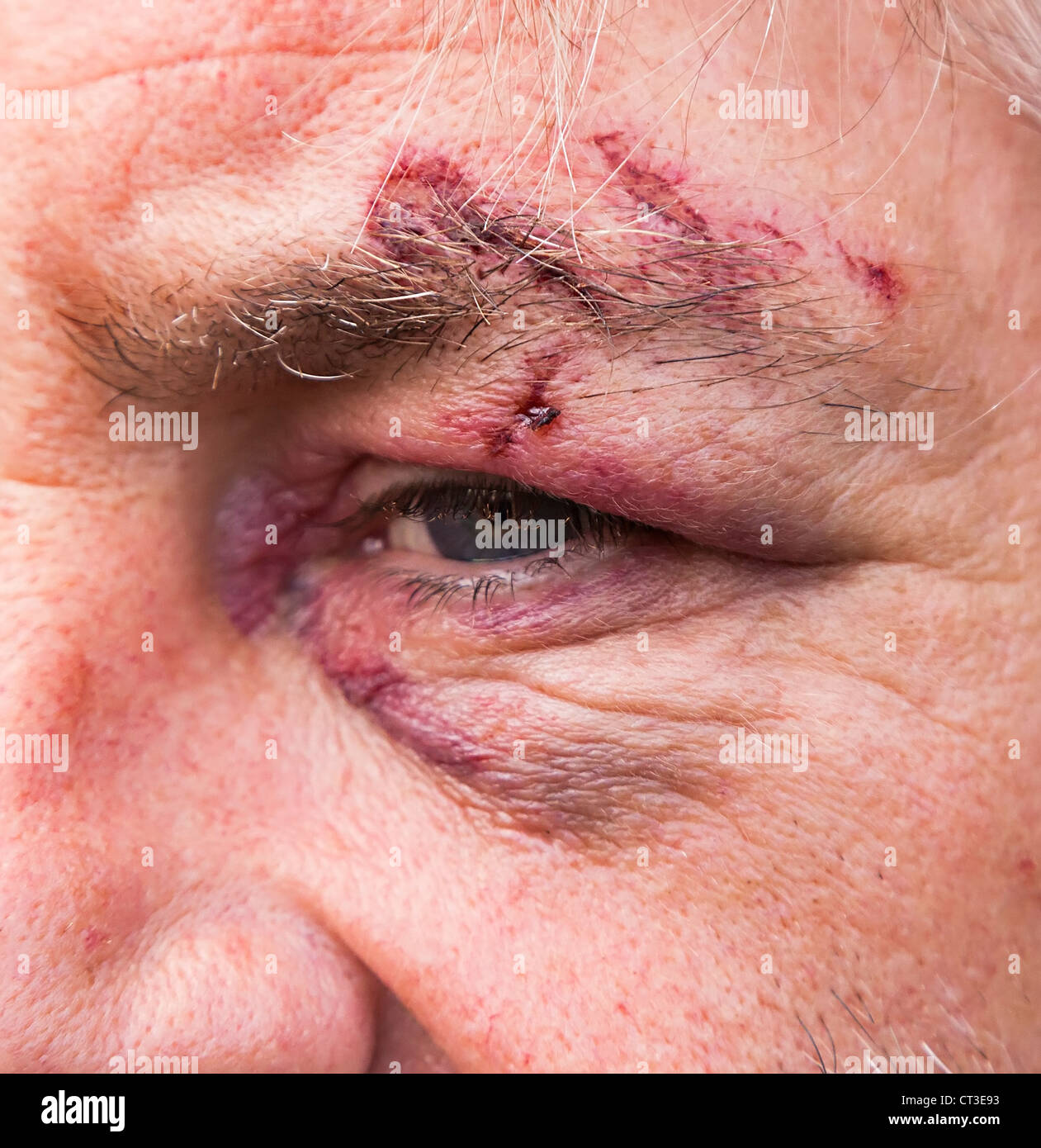 L'homme avec des yeux noirs et des blessures à sourcil, UK Banque D'Images