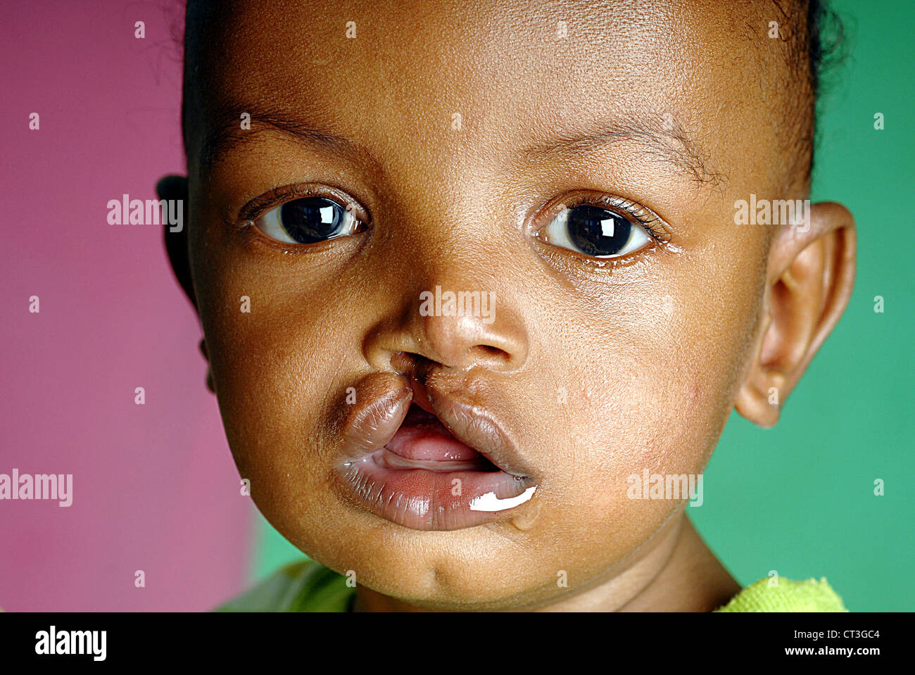 Fente Labiale Banque D Image Et Photos Alamy