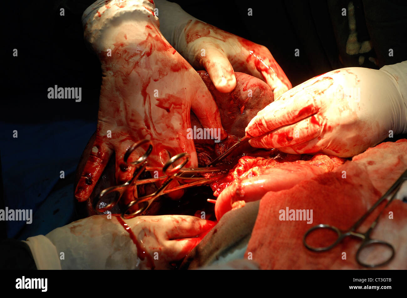 Chirurgien à l'aide d'un scalpel au transect le ligament lors d'une splénectomie. Banque D'Images