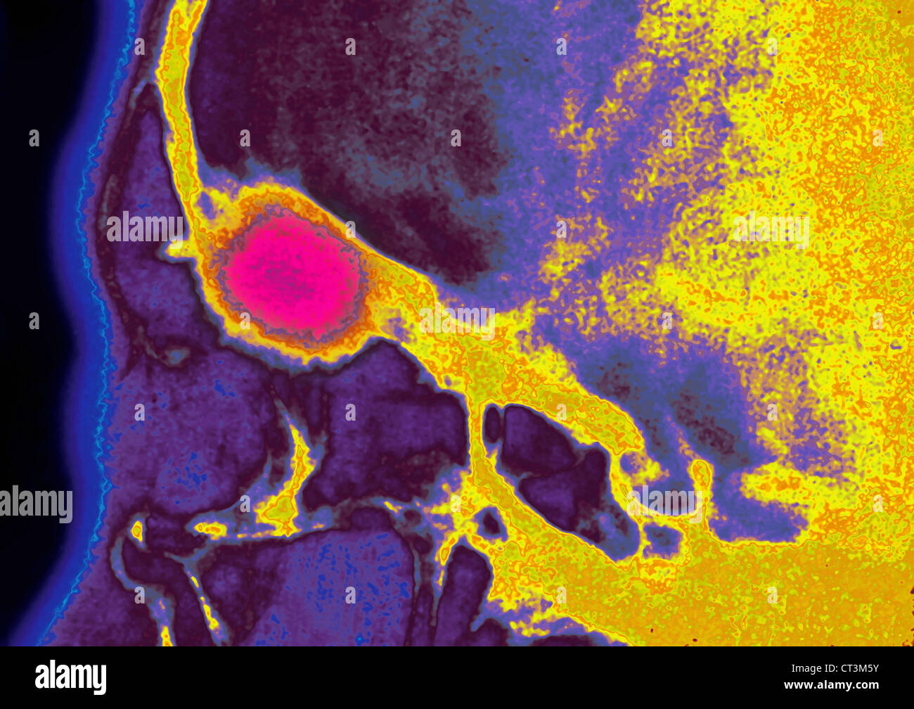 OSTEOMA, RAYONS X Banque D'Images