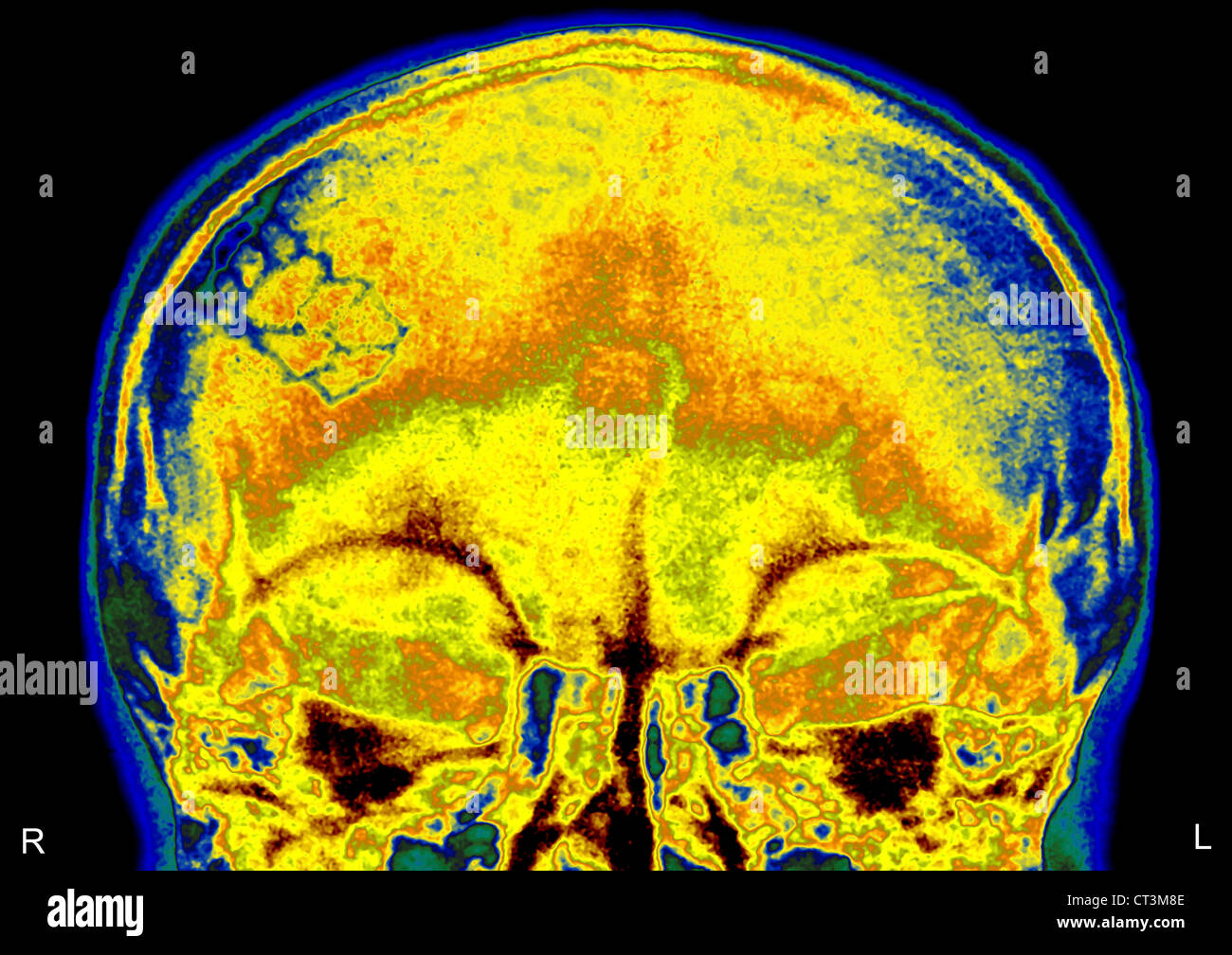 Fracture du crâne, X-RAY Banque D'Images