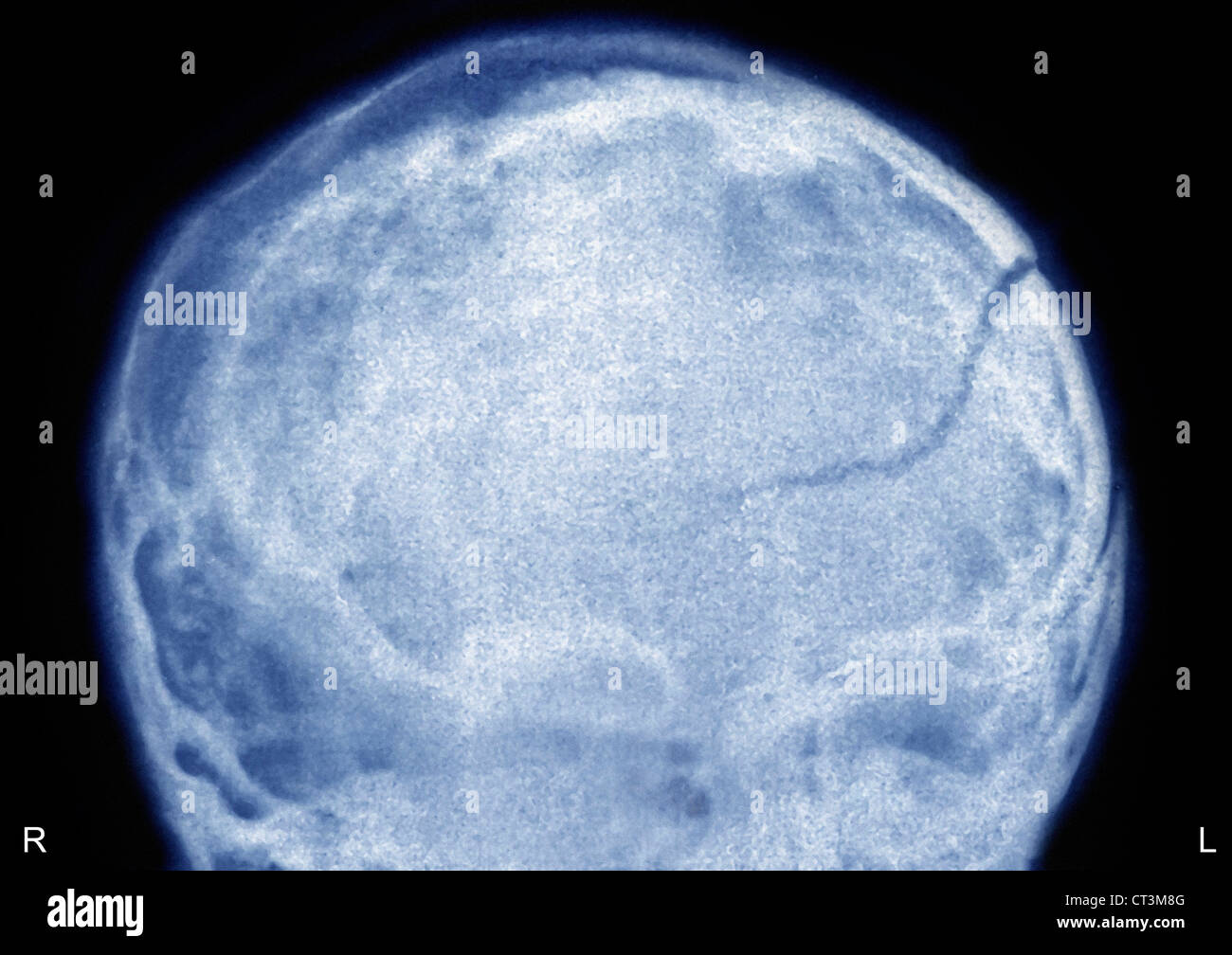 Fracture du crâne, X-RAY Banque D'Images