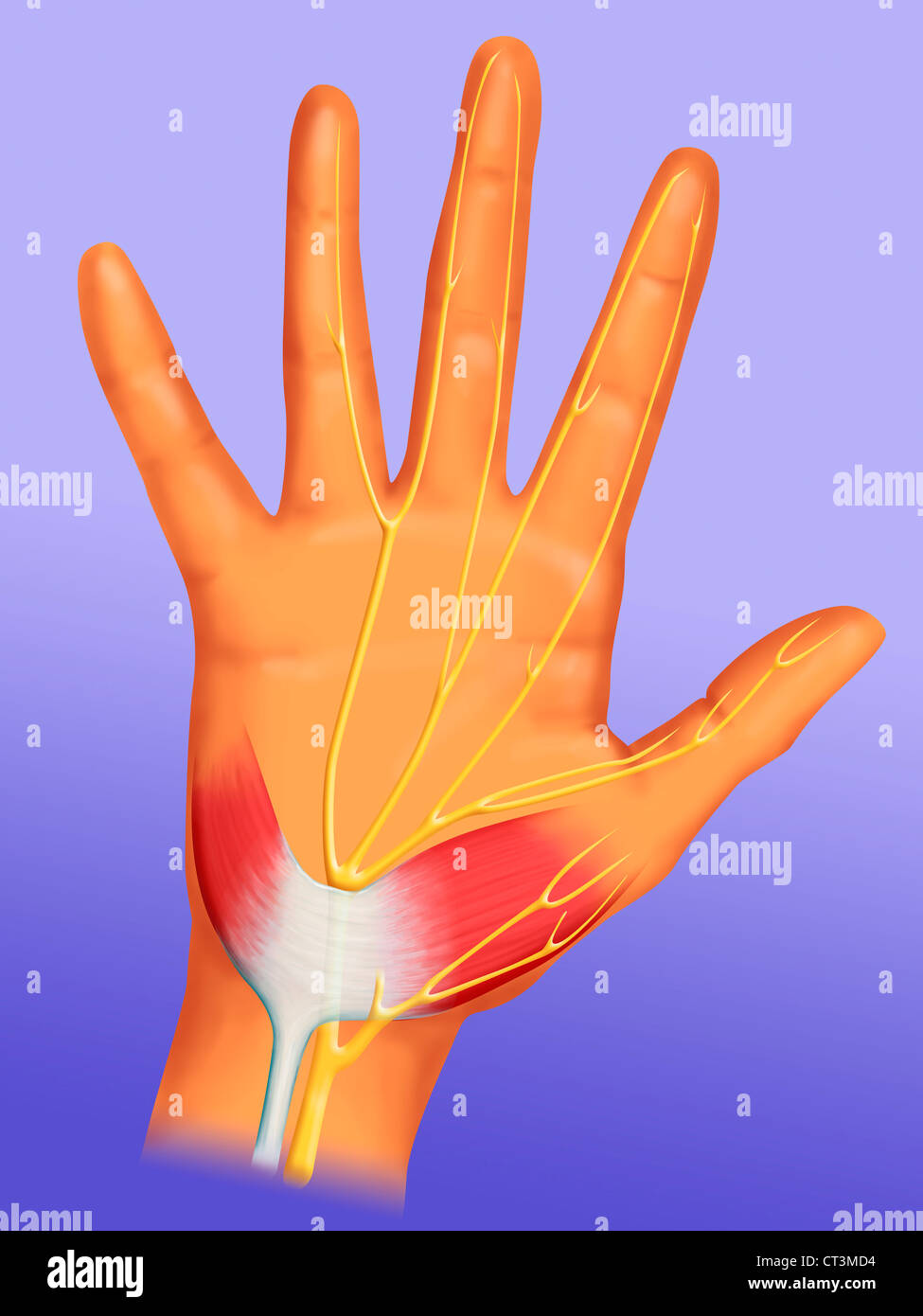 Le syndrome du tunnel carpien, dessin Banque D'Images