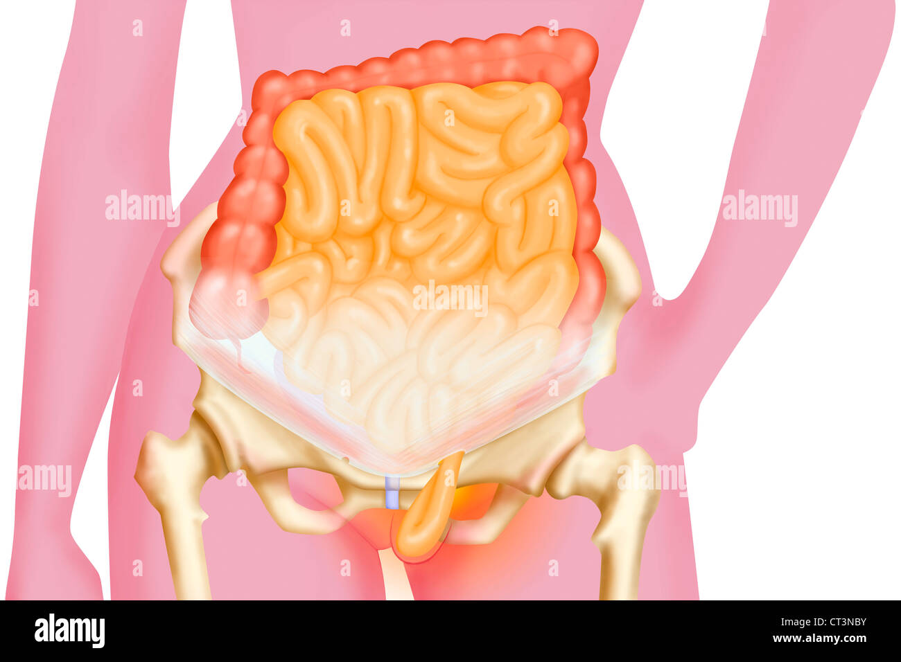 Hernie inguinale, dessin Banque D'Images