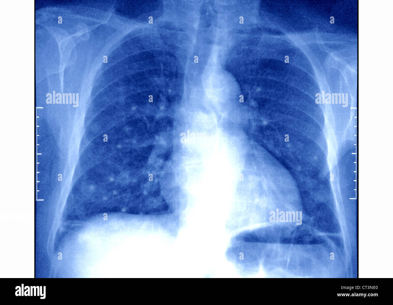 Les métastases pulmonaires, X-RAY Photo Stock - Alamy
