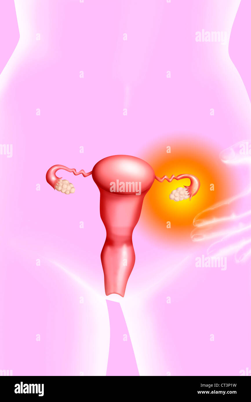 Un kyste ovarien, dessin Banque D'Images
