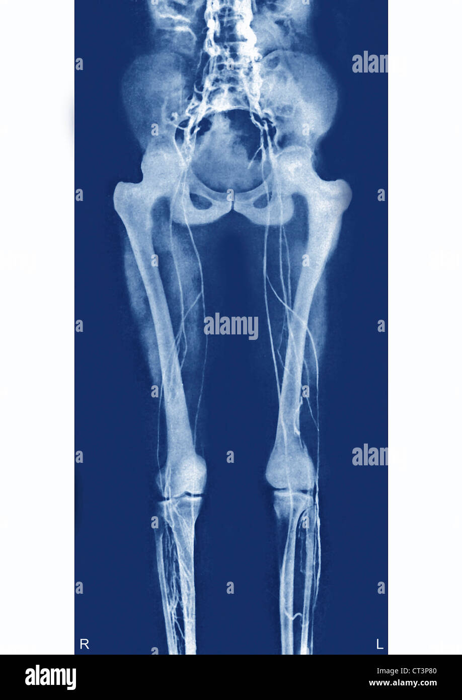 La thrombose profonde de veine Banque D'Images