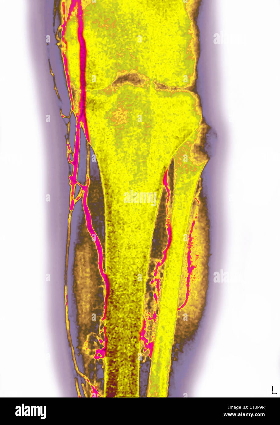 La thrombose profonde de veine Banque D'Images
