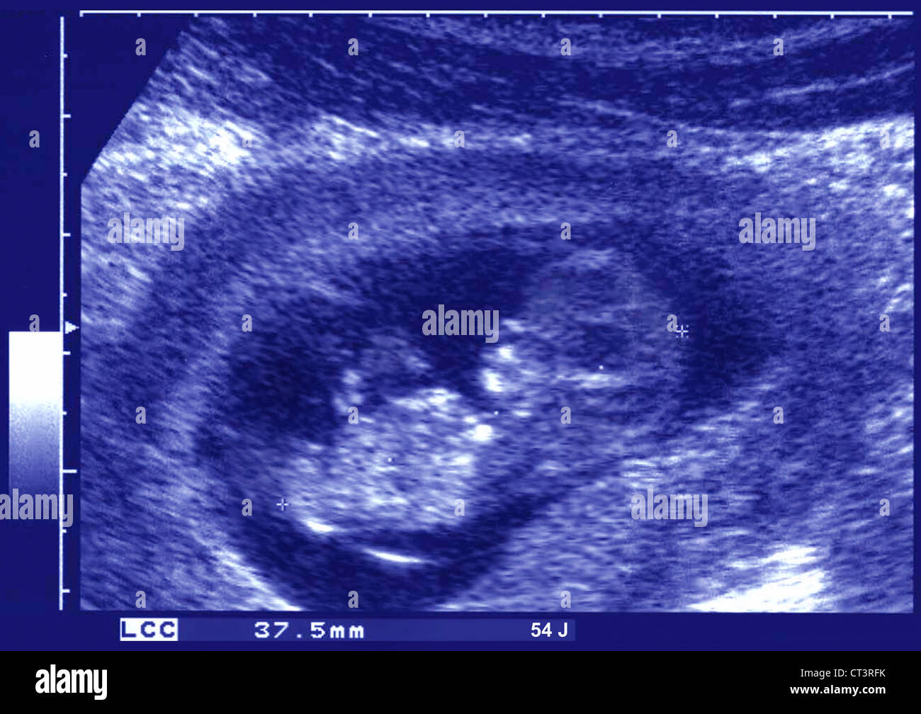 Foetus humain à 3 mois Banque de photographies et d’images à haute