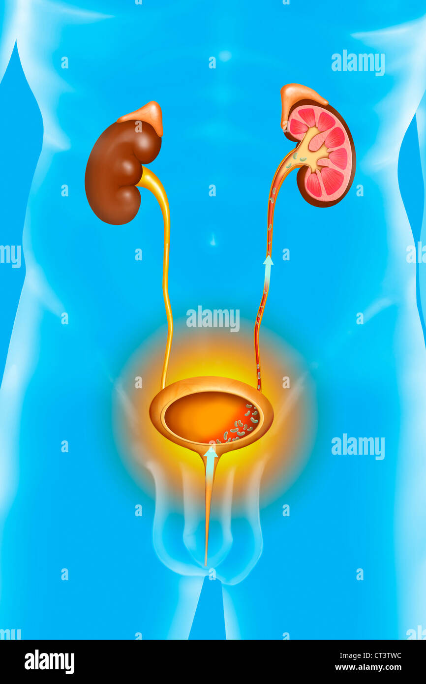 PYELOCYSTITIS, ILLUSTRATION Banque D'Images