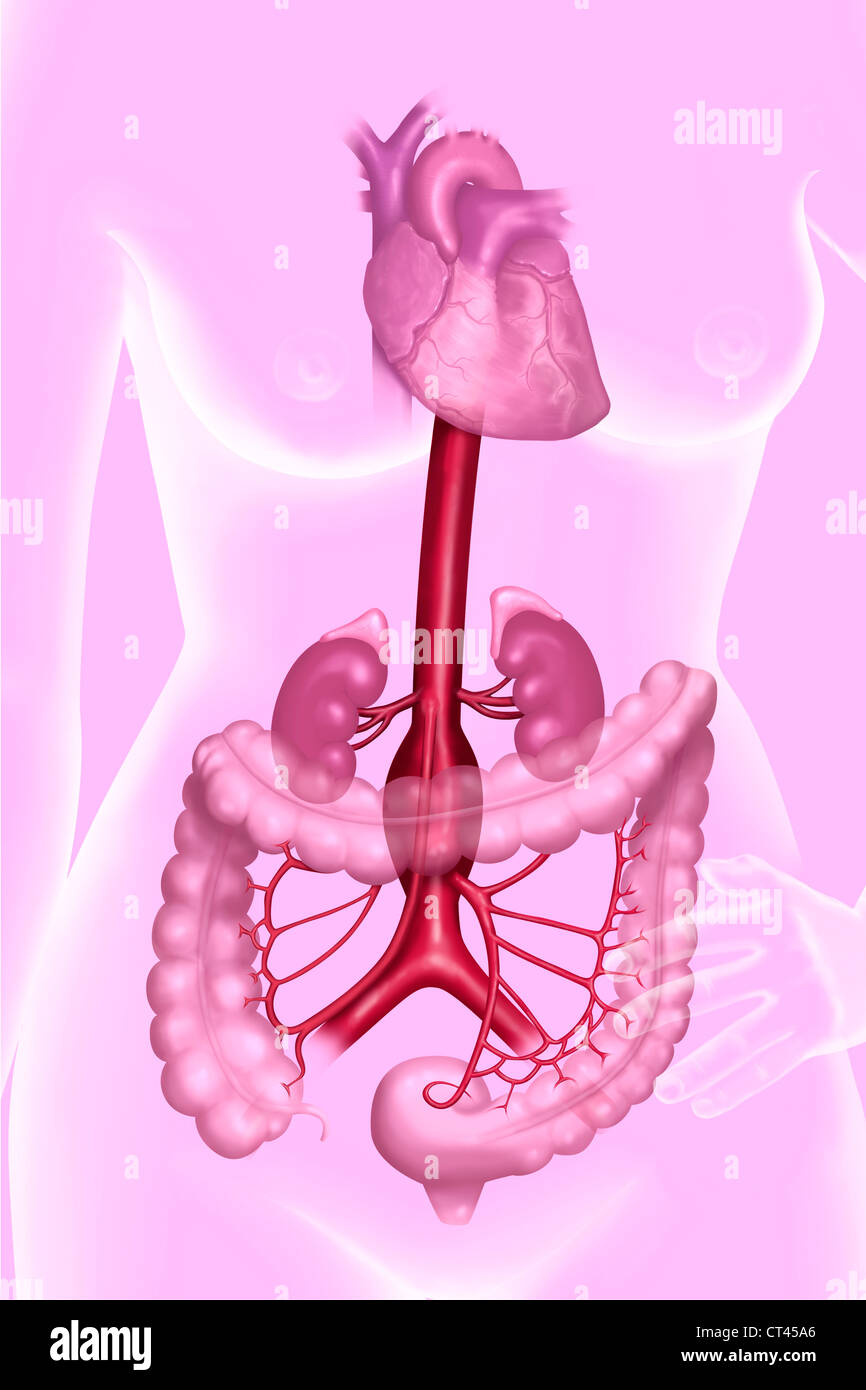 Anévrysme DE L'aorte abdominale Banque D'Images