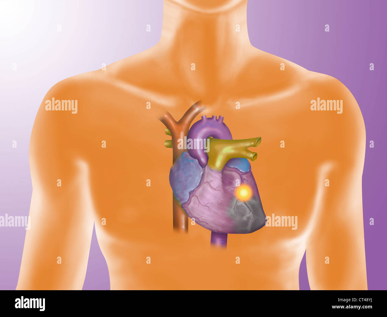 Crise cardiaque, dessin Banque D'Images