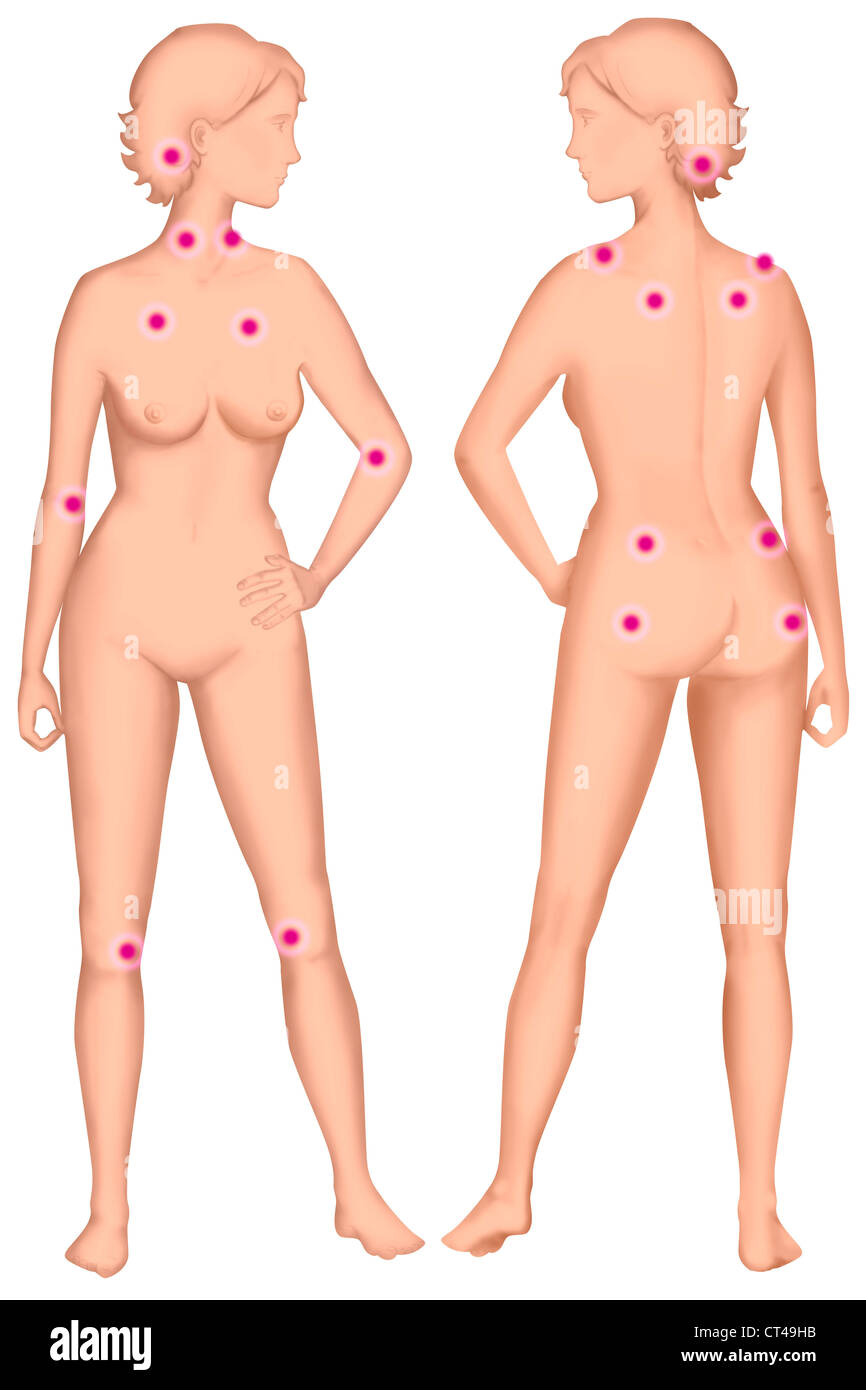 La fibromyalgie, dessin Banque D'Images