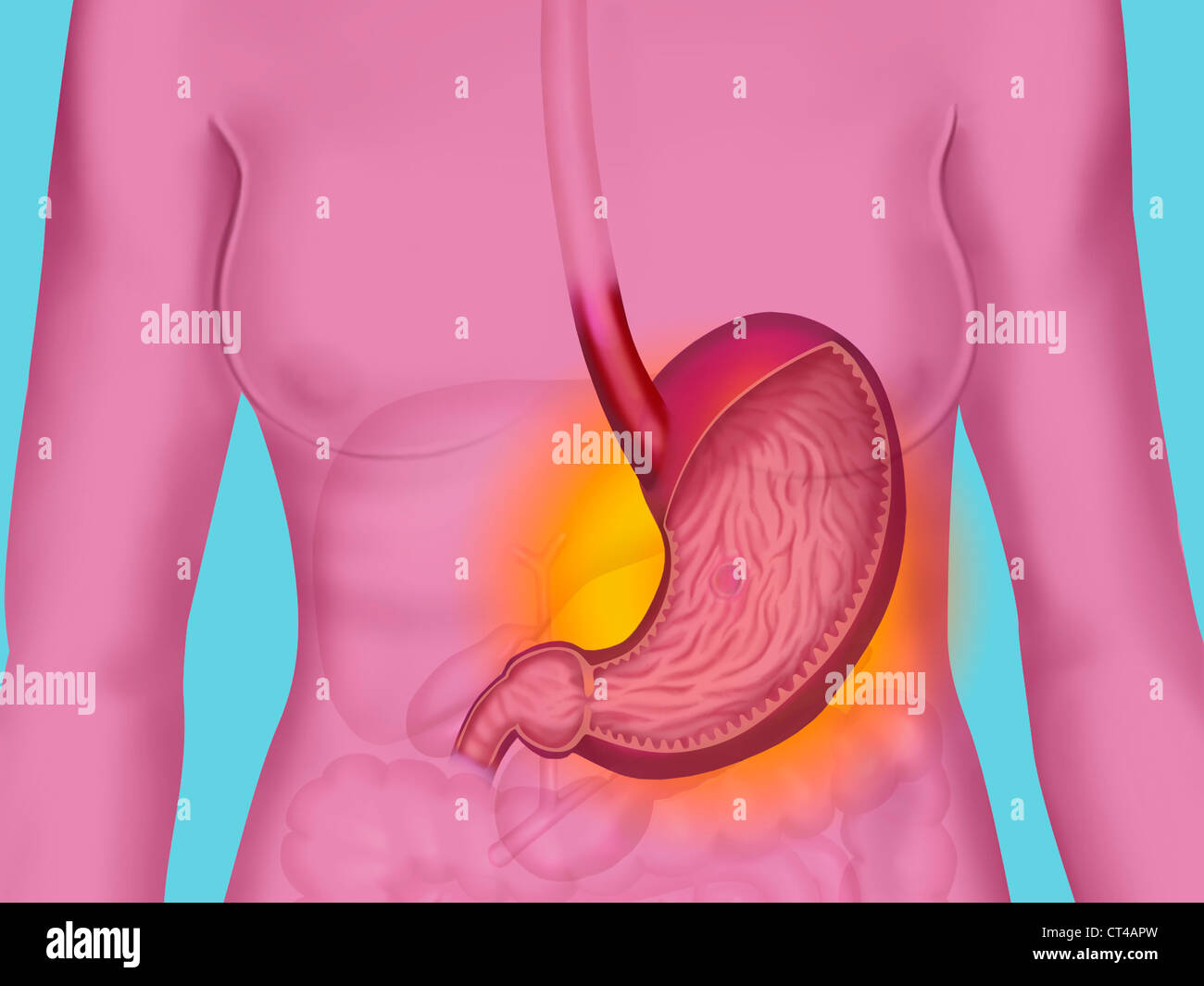 Ulcère gastrique, dessin Banque D'Images