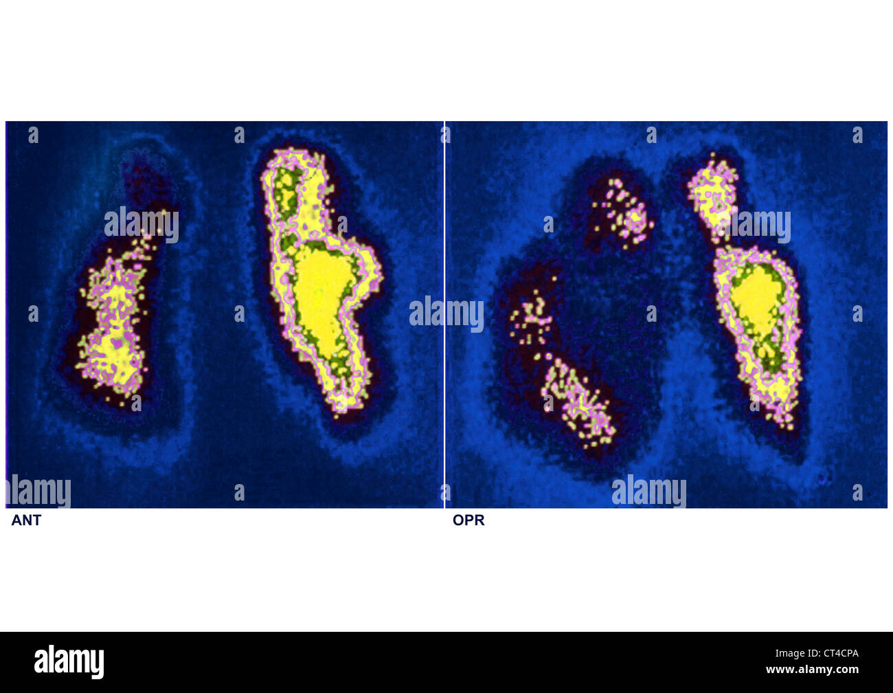 L'embolie pulmonaire, SCINTISCAN Banque D'Images