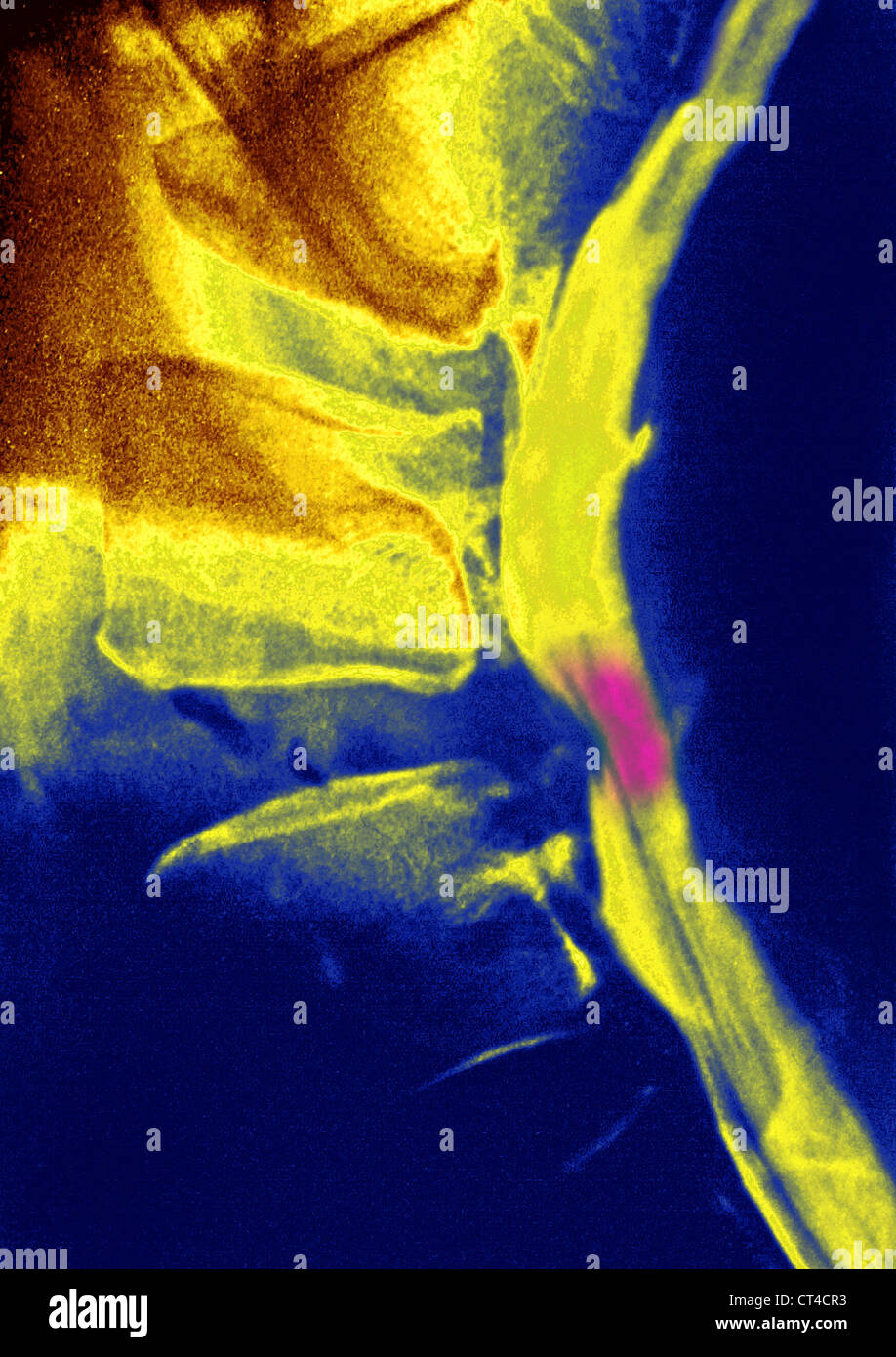 La hernie discale, X-RAY Banque D'Images