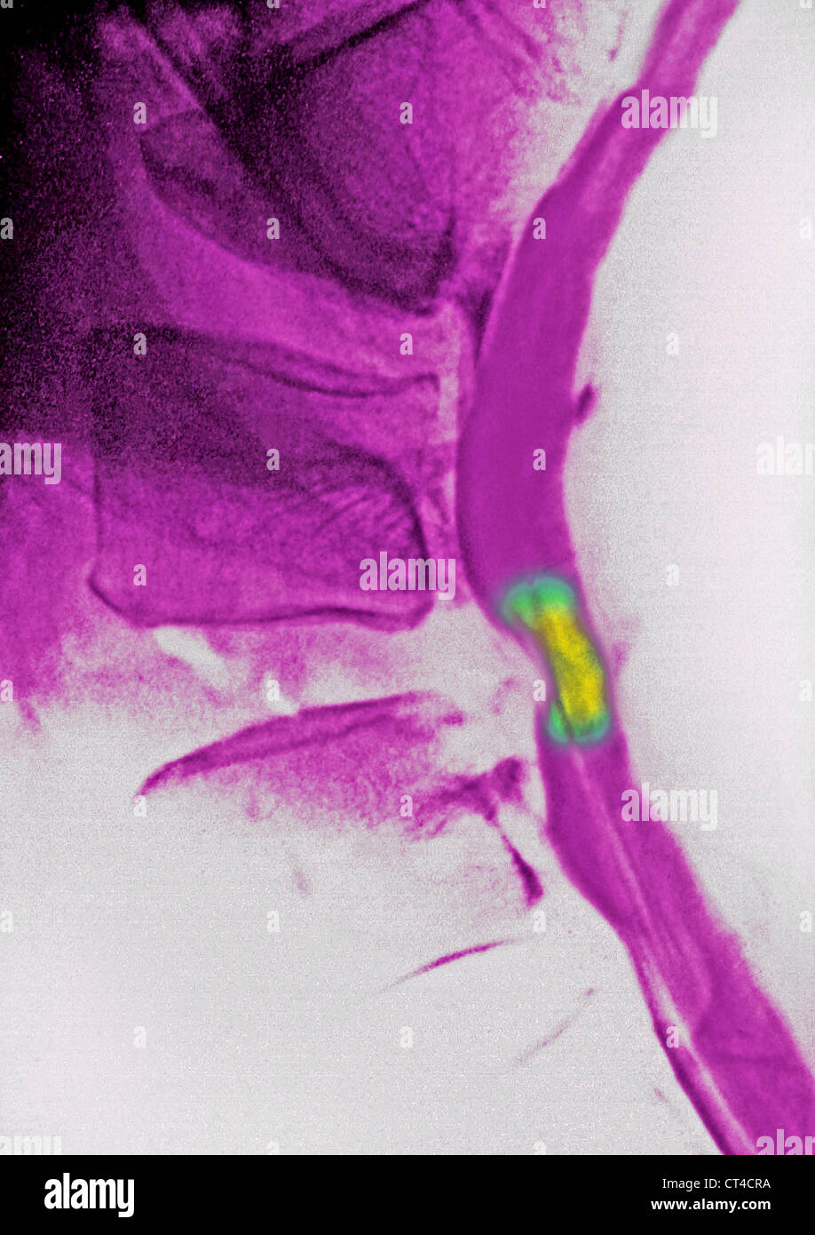 La hernie discale, X-RAY Banque D'Images