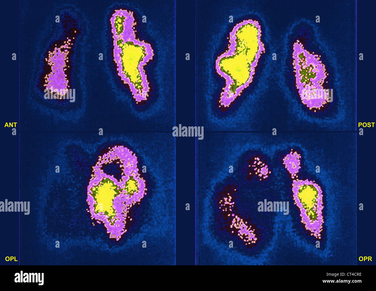 L'embolie pulmonaire, SCINTISCAN Banque D'Images