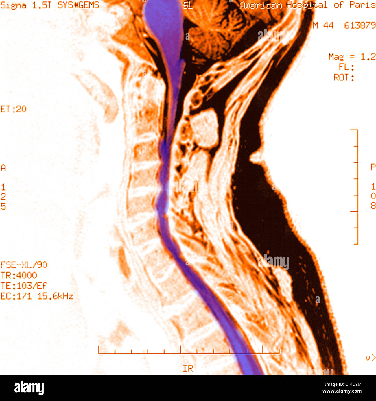 L'arthrose cervicale, IRM Banque D'Images