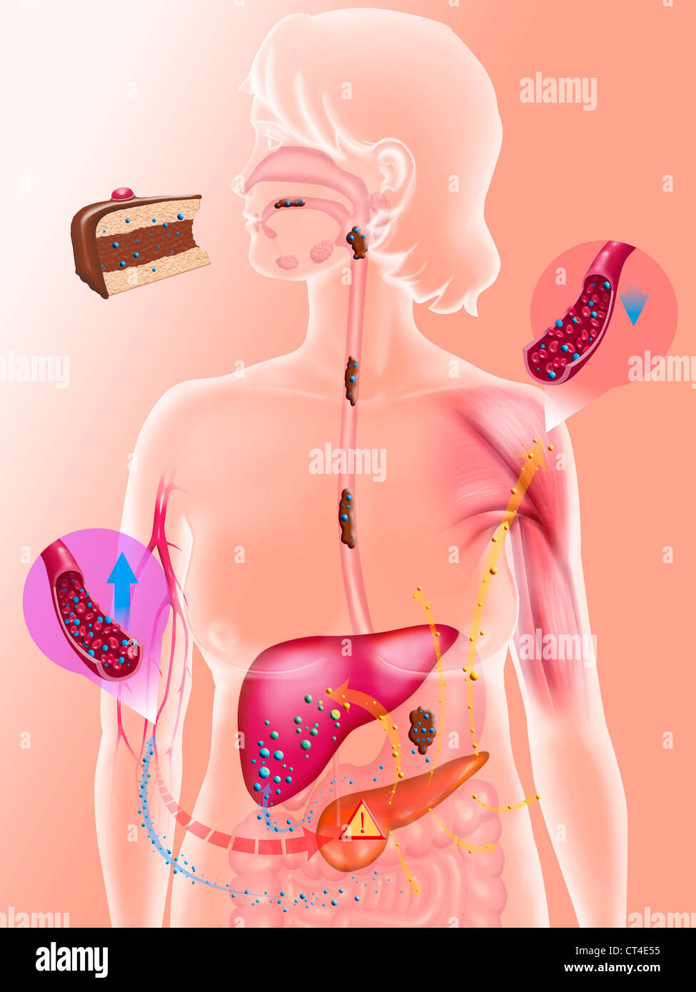 Le diabète, l'ENCOMBREMENT Banque D'Images