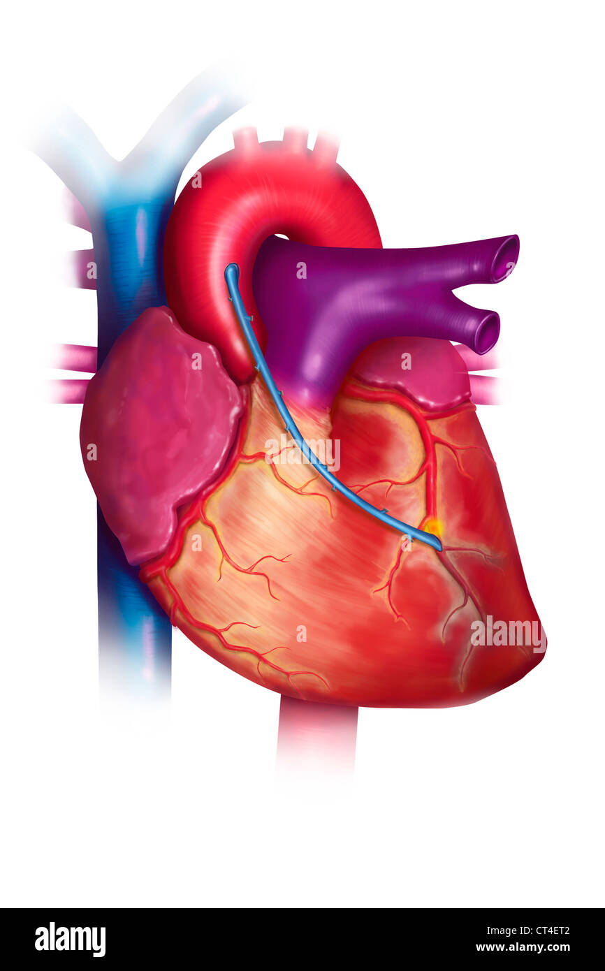 BY-PASS, ILLUSTRATION Banque D'Images