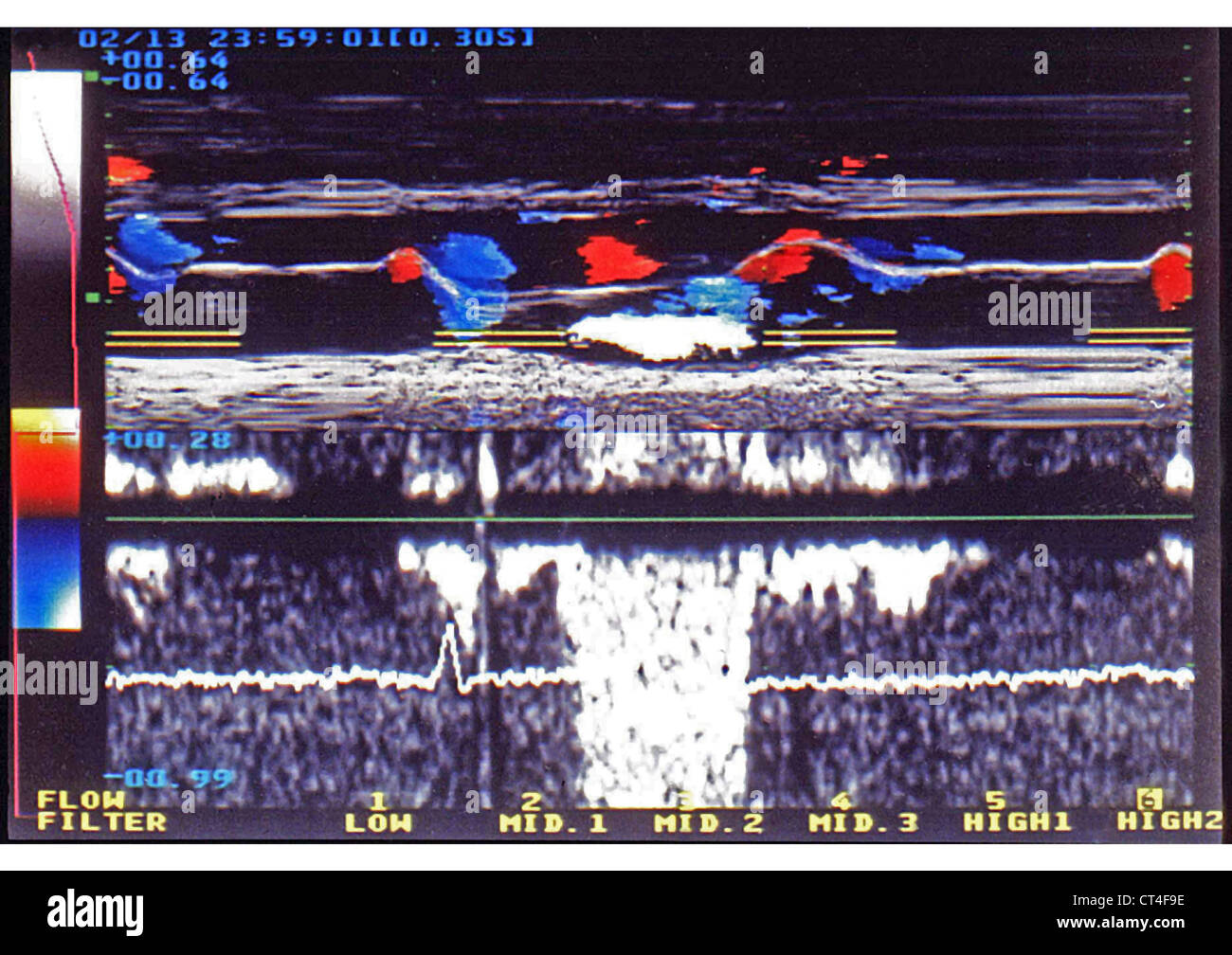 L'ultrasonographie PROLAPSUS MITRAL Banque D'Images