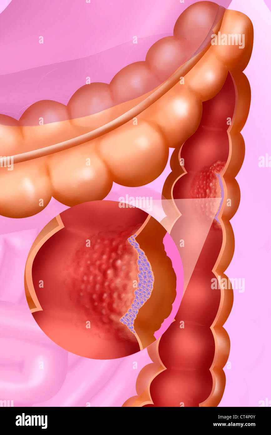 Le CANCER DU CÔLON, dessin Banque D'Images