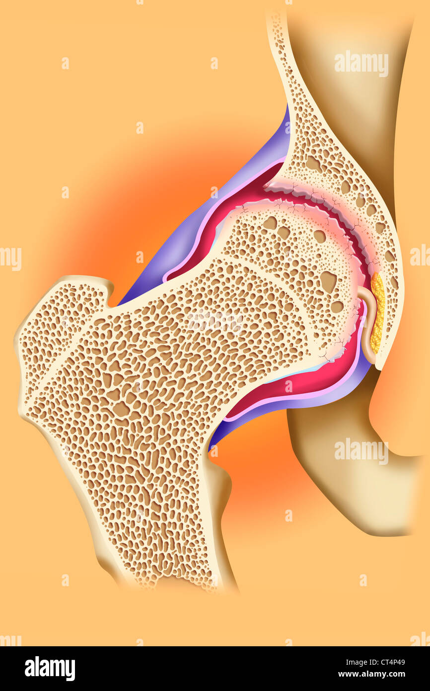 Полиартрит коленного сустава. Ревматоидный полиартрит рентген. Полиартроз суставов что такое. Полиартроз суставов что такое. Неподвижность тазобедренного сустава.
