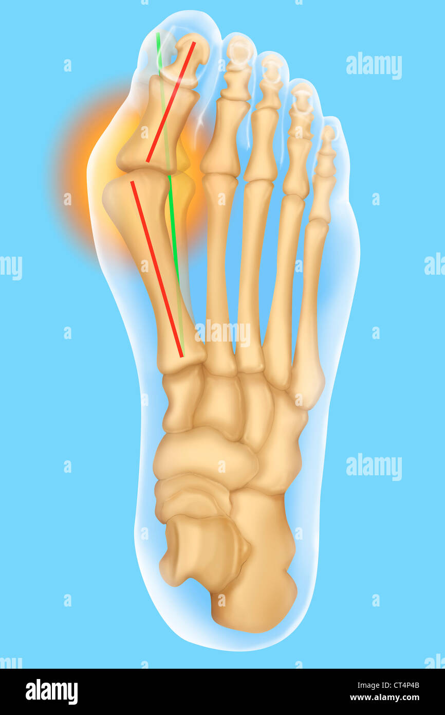L'hallux valgus, ILLUSTRATION Banque D'Images