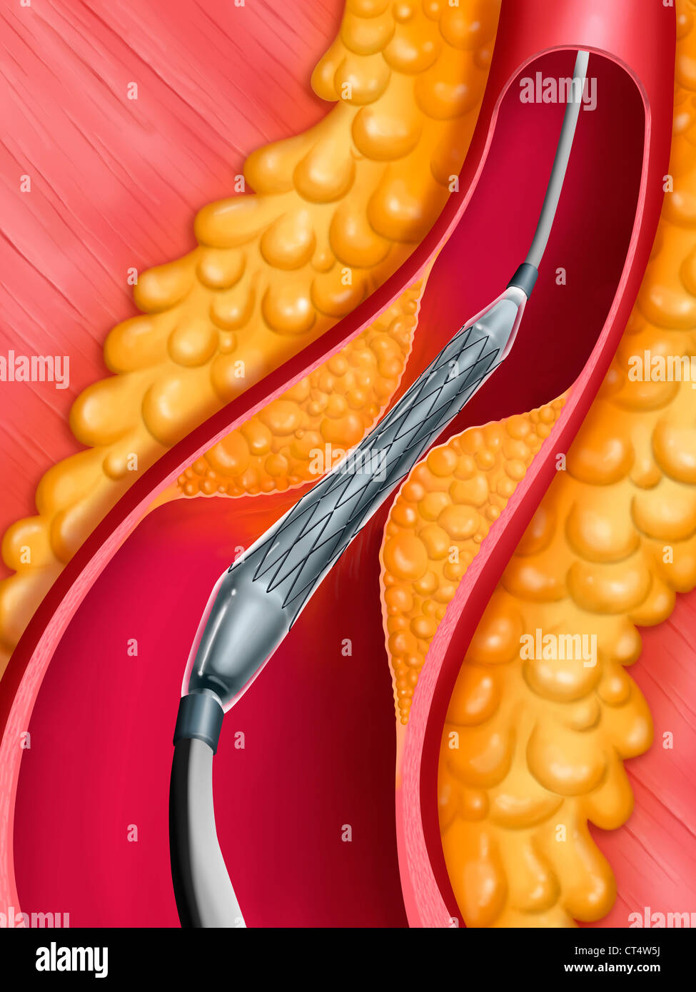 L'angioplastie artérielle, ILLUST. Banque D'Images