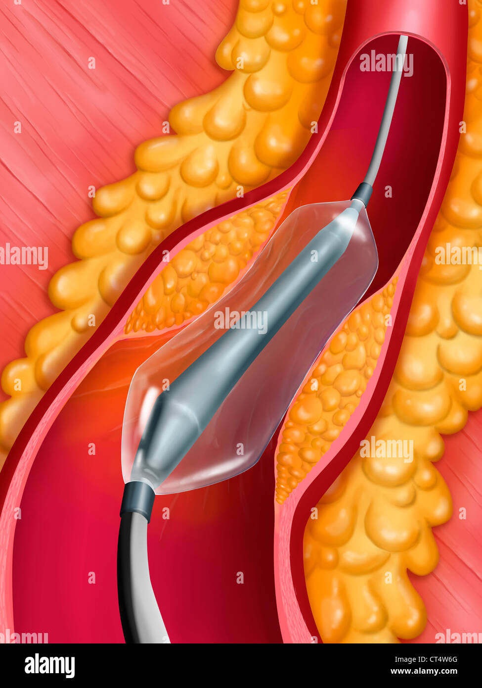 L'angioplastie artérielle, ILLUST. Banque D'Images