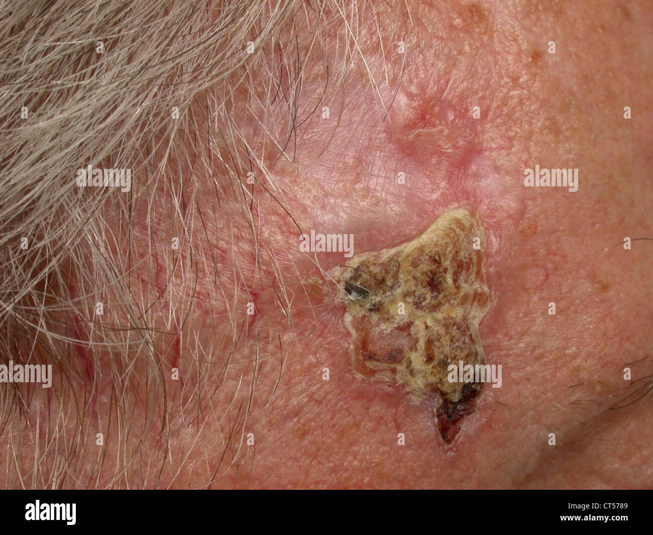 Cancers du visage Banque de photographies et d’images à haute
