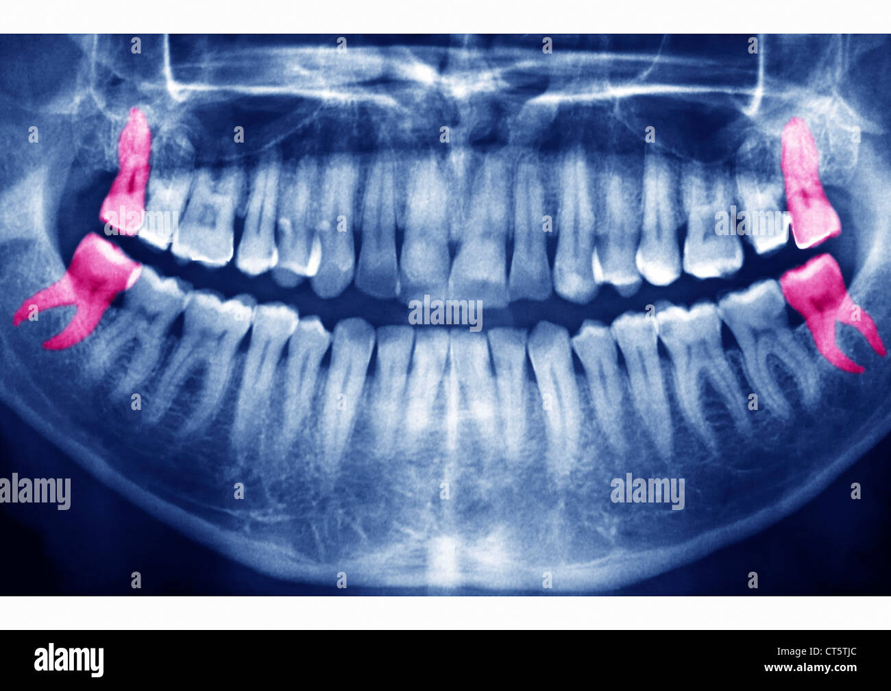 Dent de sagesse, X RAY Banque D'Images