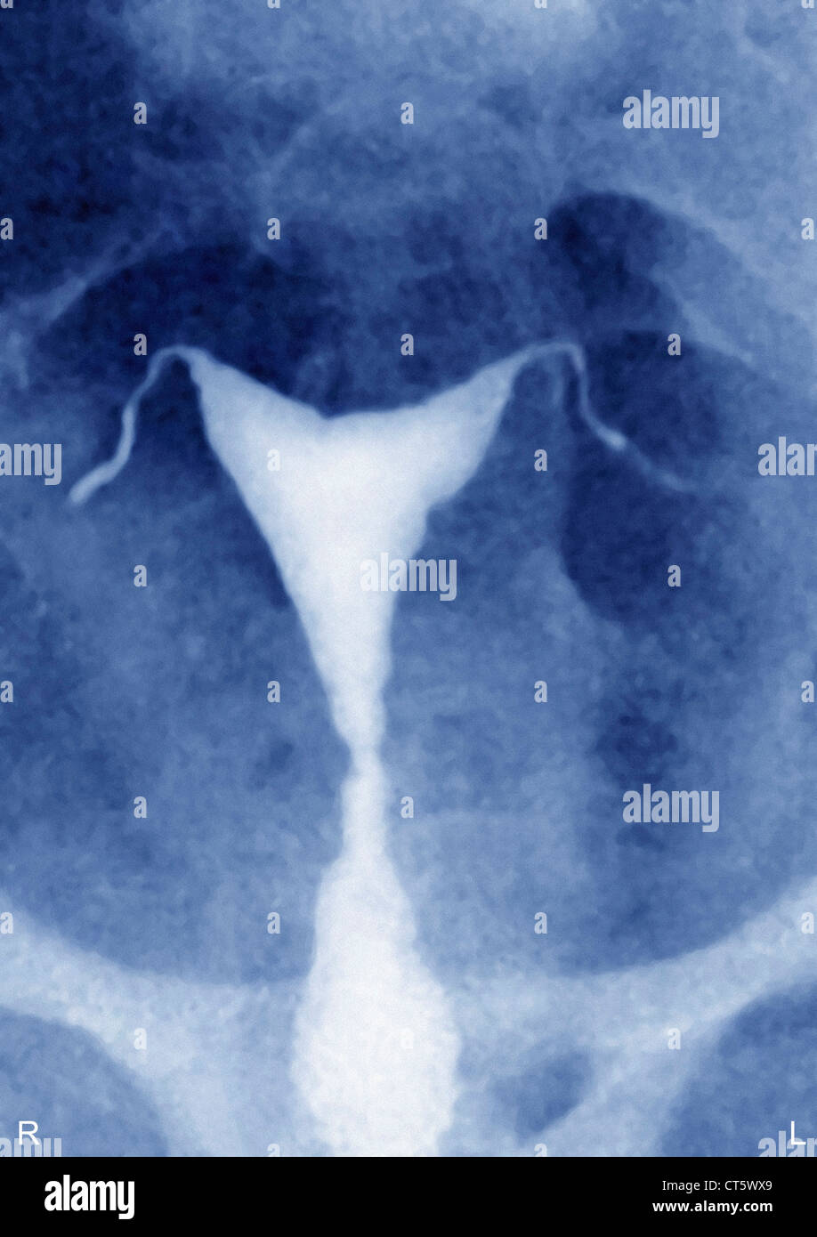 D'UNE OBSTRUCTION DE L'UTÉRUS, X-RAY Banque D'Images