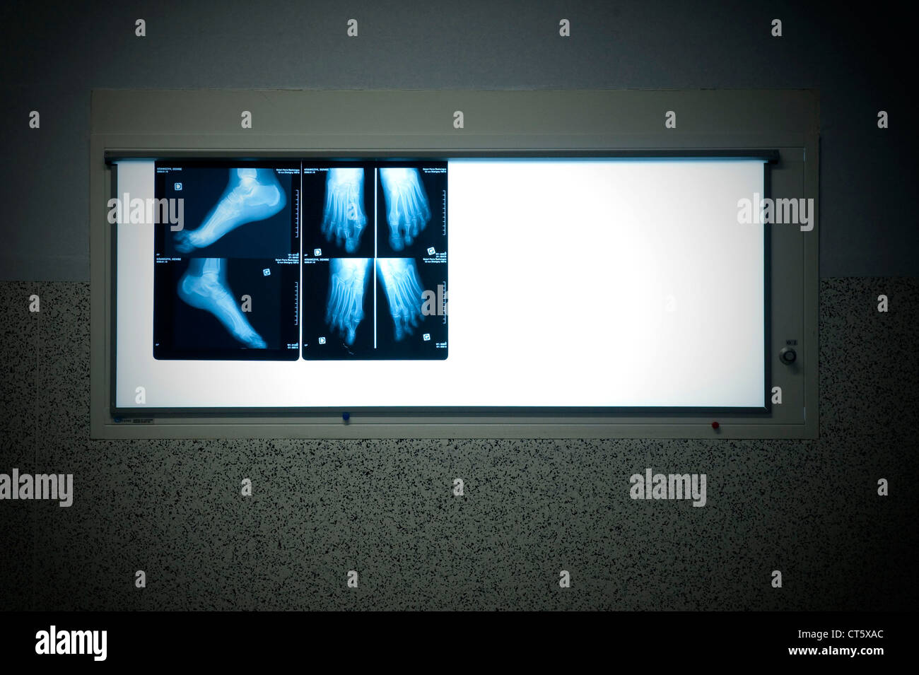 L'hallux valgus, X-RAY Banque D'Images