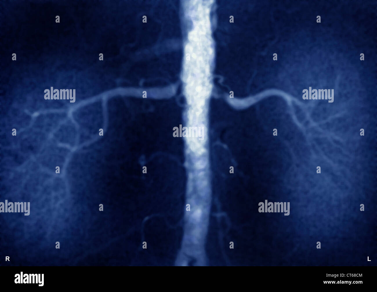 Une sténose de l'artère rénale gauche Photo Stock - Alamy