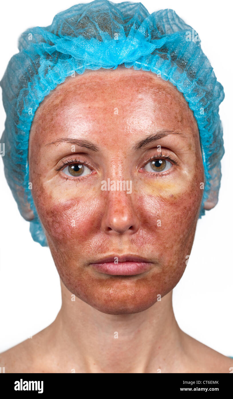 L'état de la peau après le peeling chimique du TCA Photo Stock - Alamy