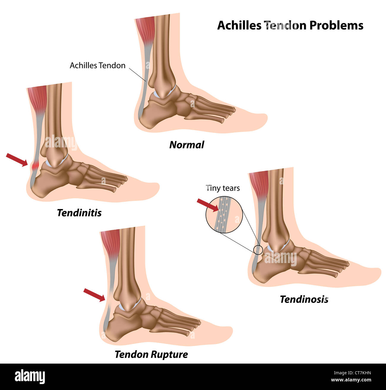 Problèmes au tendon d'Achille Banque D'Images