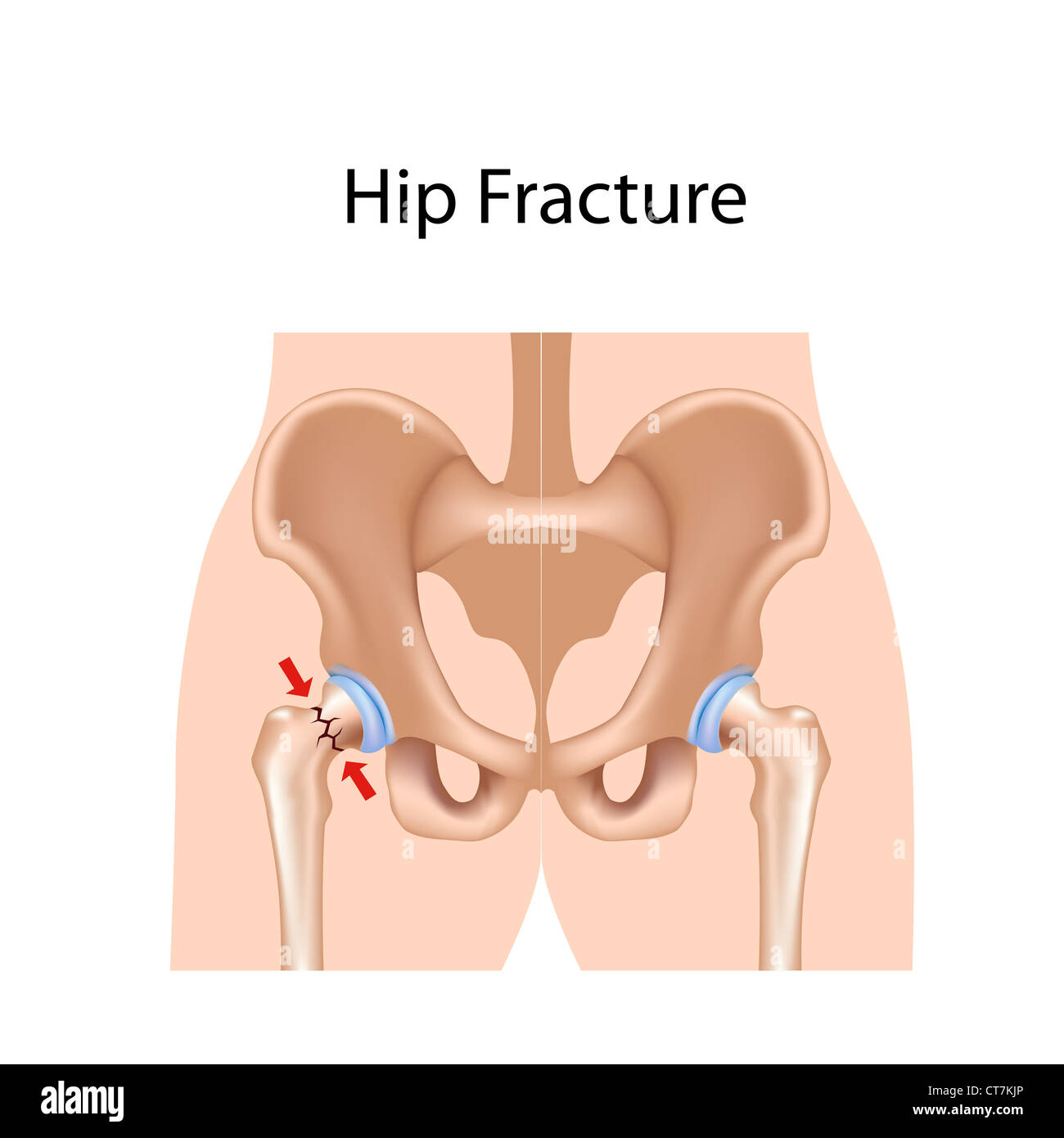 Fracture de la hanche Banque D'Images
