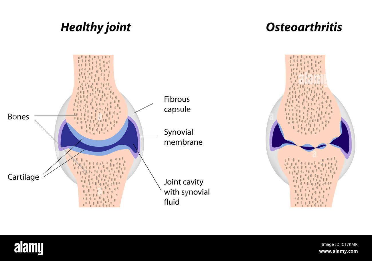 Articulations synoviales normal et de l'arthrite Banque D'Images