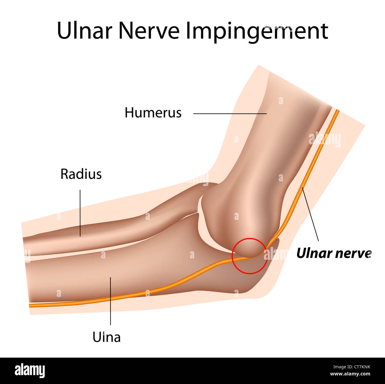 Nerf ulnaire syndrome du tunnel cubital et Banque D'Images