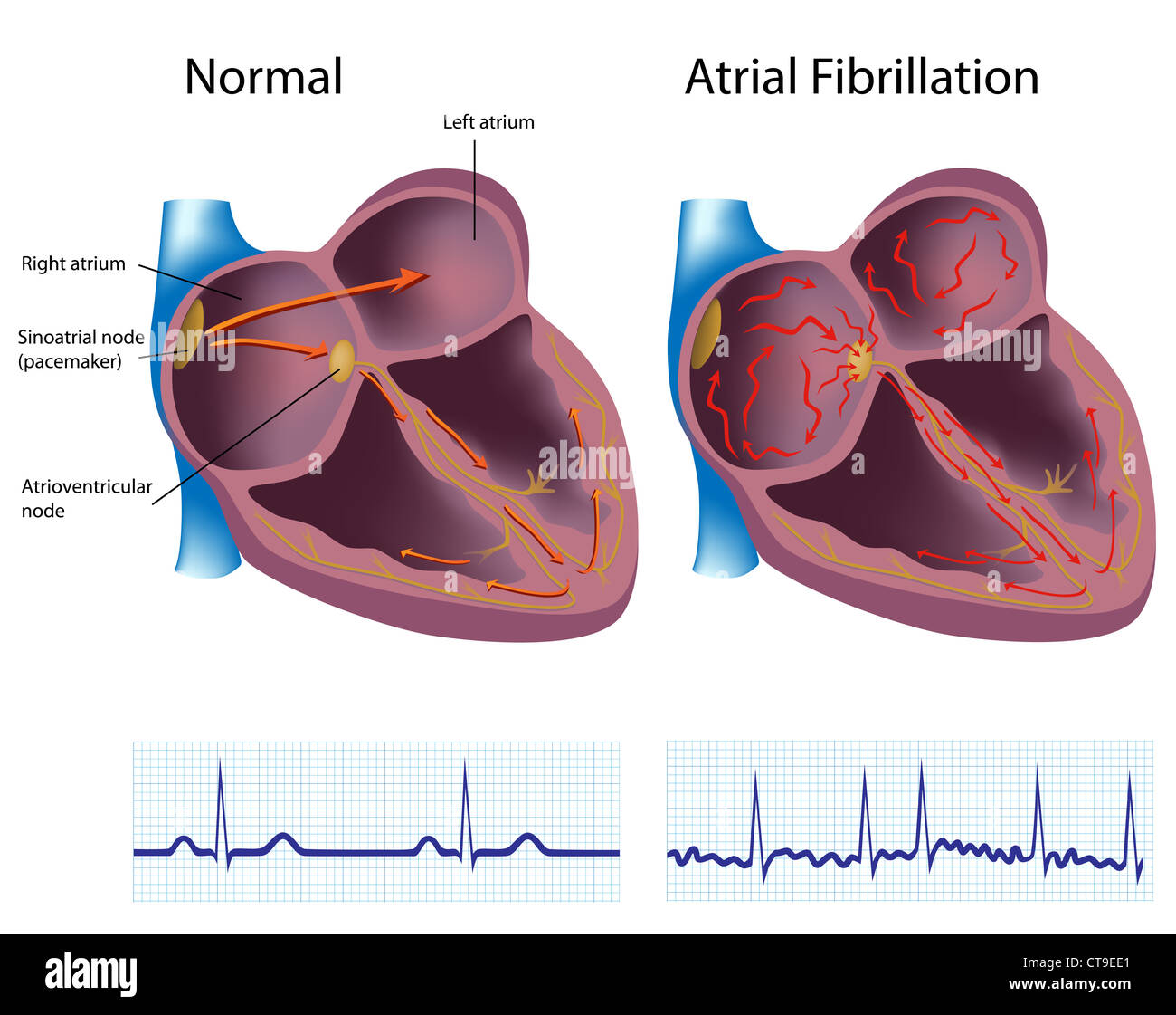 La fibrillation auriculaire Banque D'Images