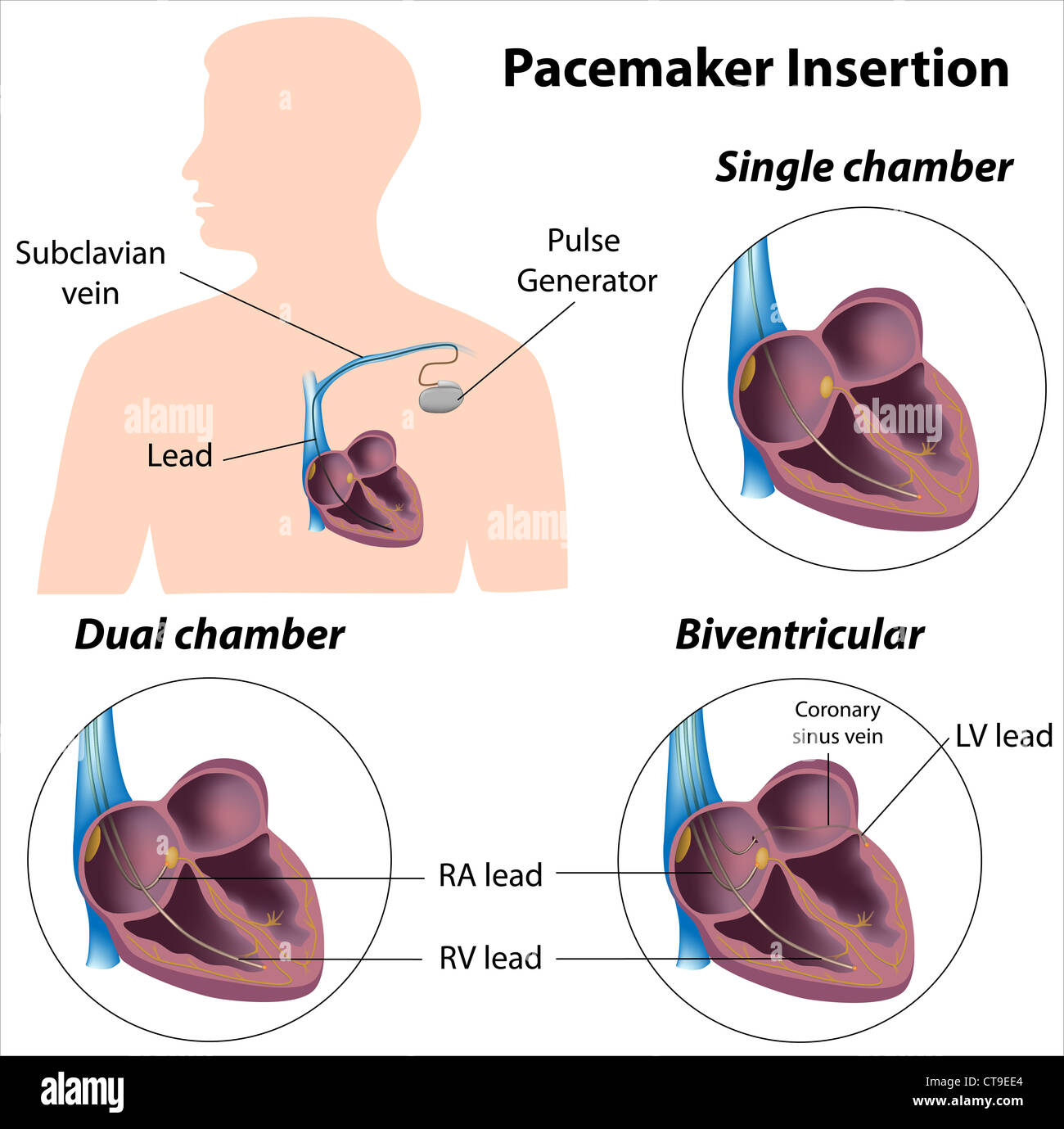 La chirurgie d'insertion du stimulateur Banque D'Images