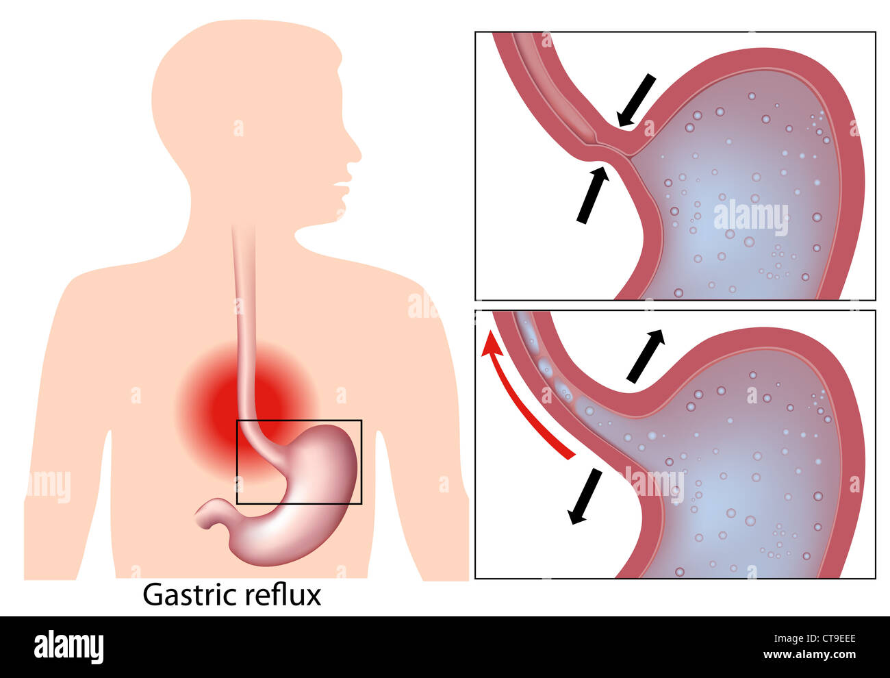 Le reflux acide de l'estomac (mécanisme) Banque D'Images