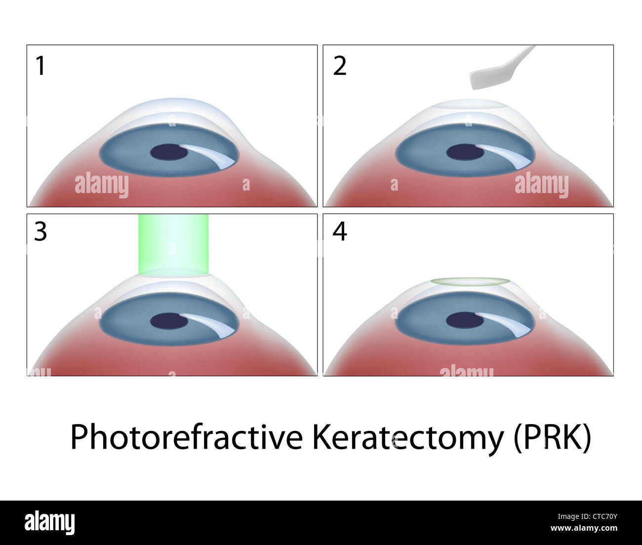 La kératectomie photoréfractive (PRK) Chirurgie Banque D'Images