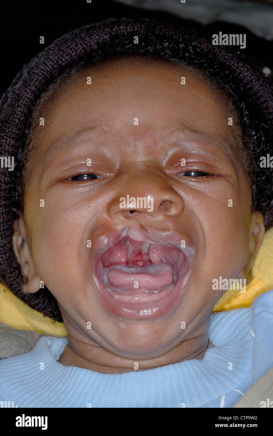 Une Fente Labiale Et Fente Palatine Sur Un Jeune Bebe Nigerian Photo Stock Alamy