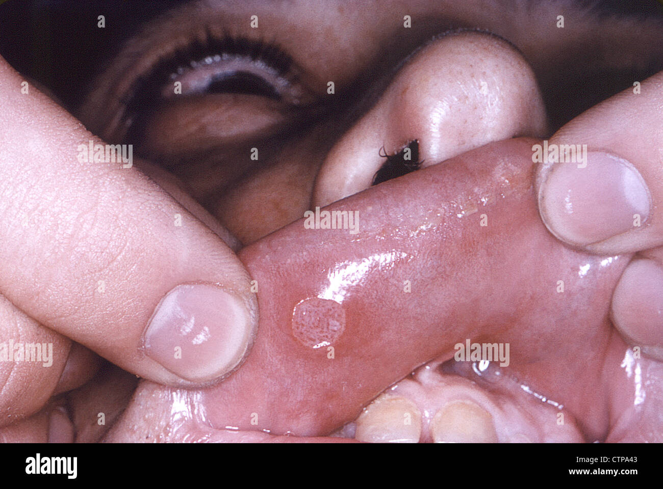 Bouton de fièvre ou d'un bouton de fièvre sur la lèvre causé par  l'infection d'herpès Photo Stock - Alamy